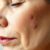 Objawy skórne menopauzy – jak je rozpoznać i leczyć?